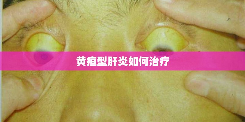 黄疸型肝炎如何治疗