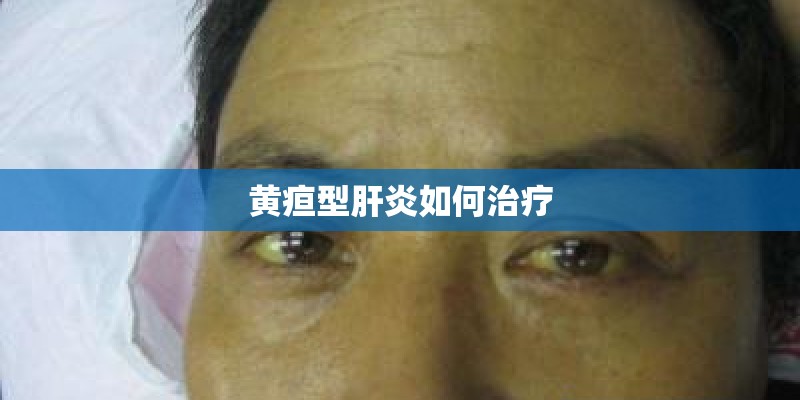 黄疸型肝炎如何治疗